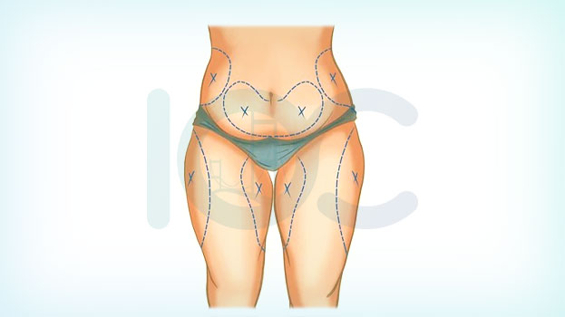 Post Bariatrik Cerrahi Liposuction