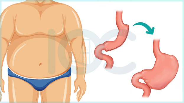 Was sind die Ursachen einer Magenvergrößerung nach einer Schlauchmagenoperation?